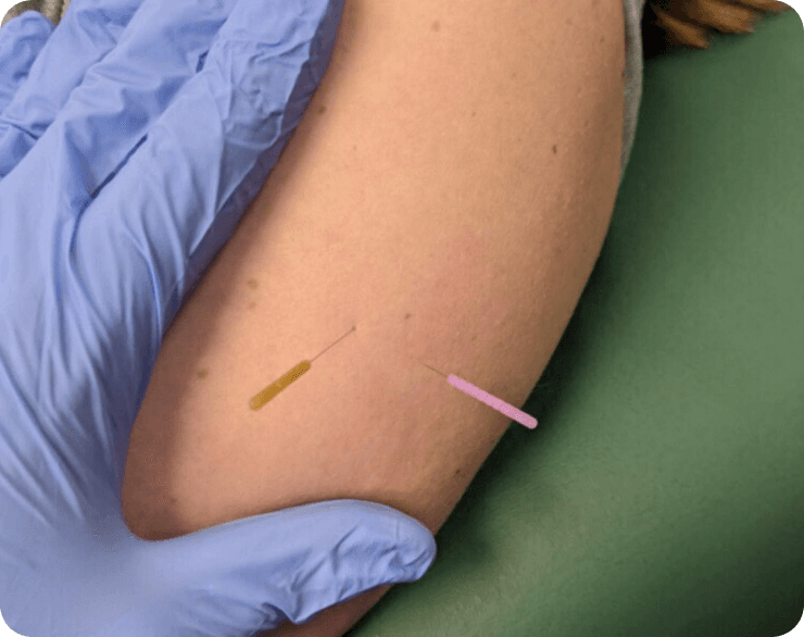 Dry Needling